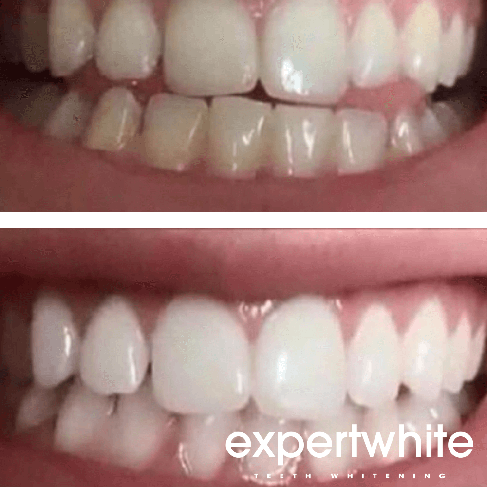 Expertwhite Teeth Whitening Expertwhite Ultra+ 44% Teeth Whitening Gel – 20 Pack | Save 50%
