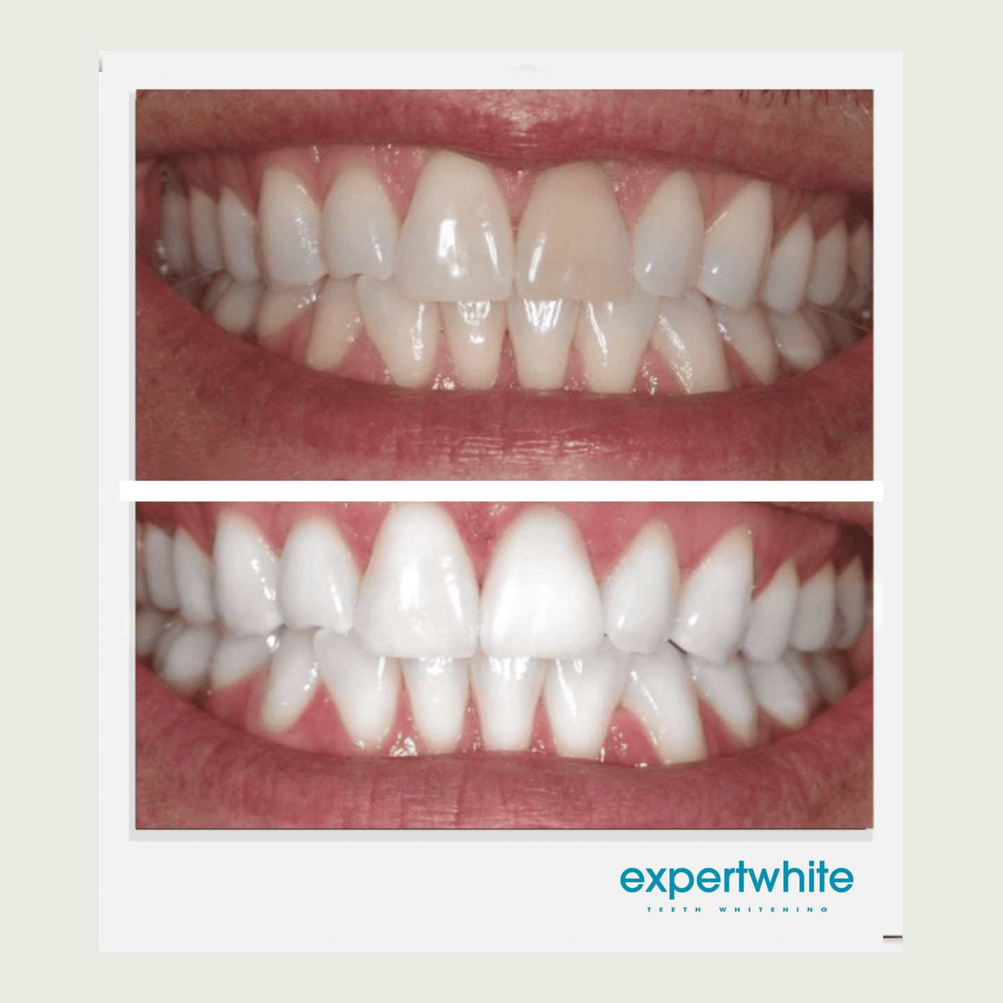Expertwhite Teeth Whitening Kit LED Insane Results Teeth Whitening Kit (Brush-on gel & LED)