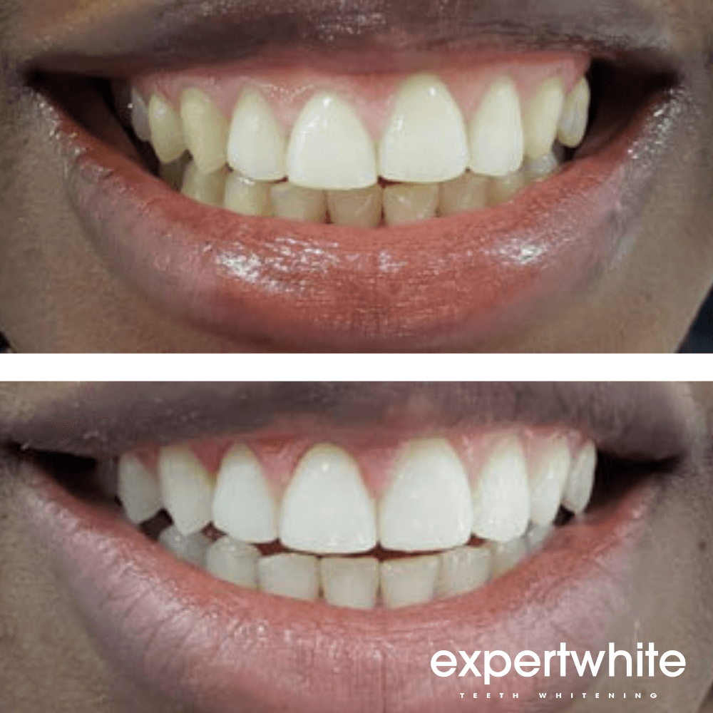 Expertwhite Teeth Whitening Kit LED InstaGlo Kit