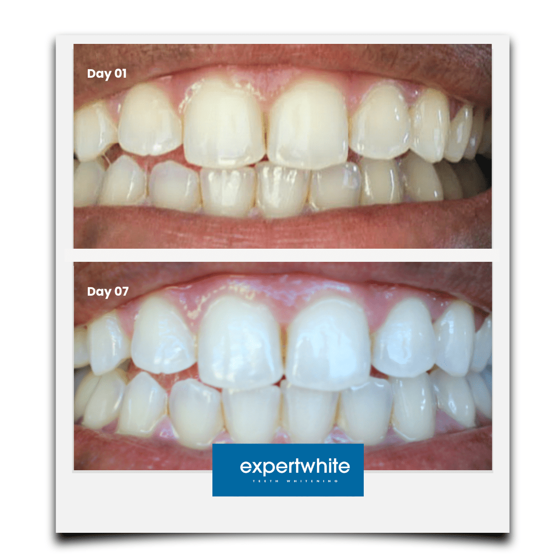 Expertwhite Teeth Whitening strips Max+ Instant Teeth Whitening Strips
Professional-Grade. Advanced Dry-Tech. No Slip. Stains Gone.