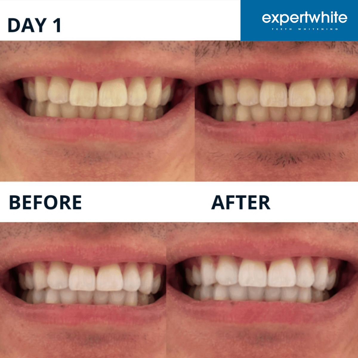 Expertwhite Teeth Whitening strips Max+ Instant Teeth Whitening Strips
Professional-Grade. Advanced Dry-Tech. No Slip. Stains Gone.