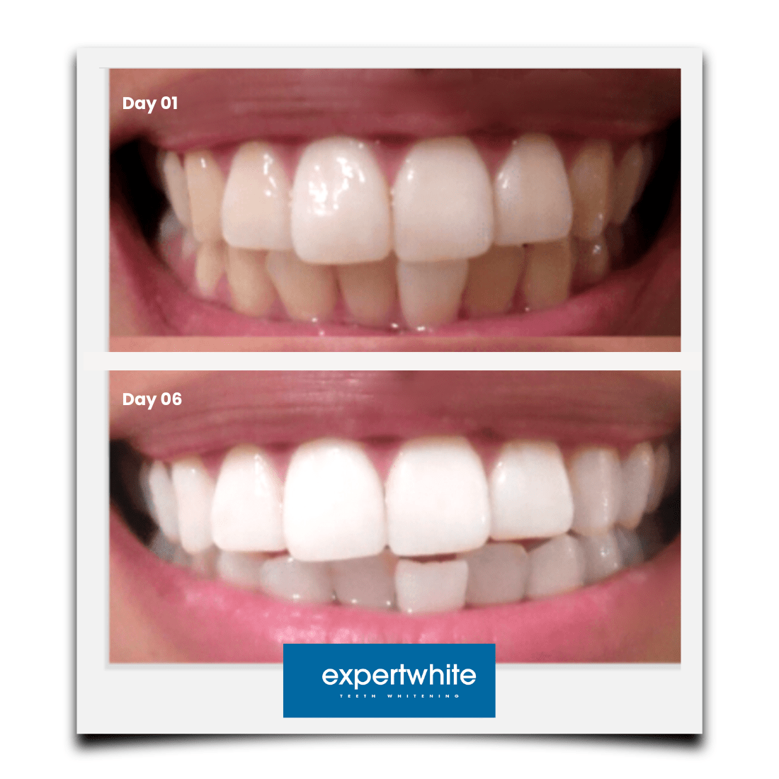 Expertwhite Teeth Whitening strips Max+ Instant Teeth Whitening Strips
Professional-Grade. Advanced Dry-Tech. No Slip. Stains Gone.