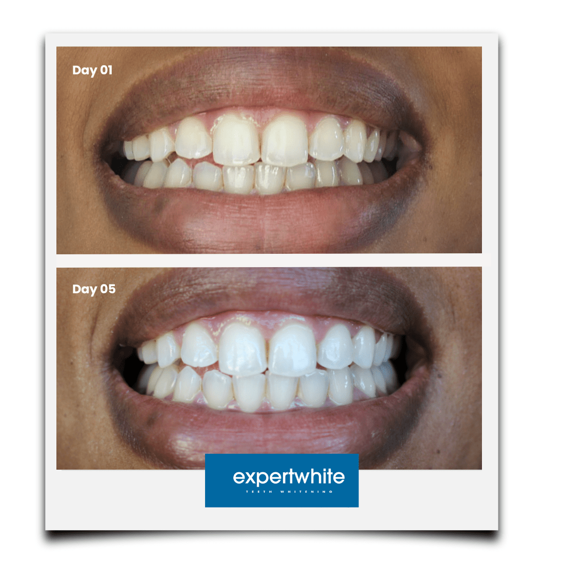 Expertwhite Teeth Whitening strips Max+ Instant Teeth Whitening Strips
Professional-Grade. Advanced Dry-Tech. No Slip. Stains Gone.