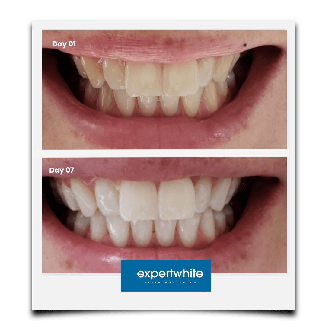 Expertwhite Teeth Whitening Trays Kit Expertwhite Max+ Prefilled Whitening Trays