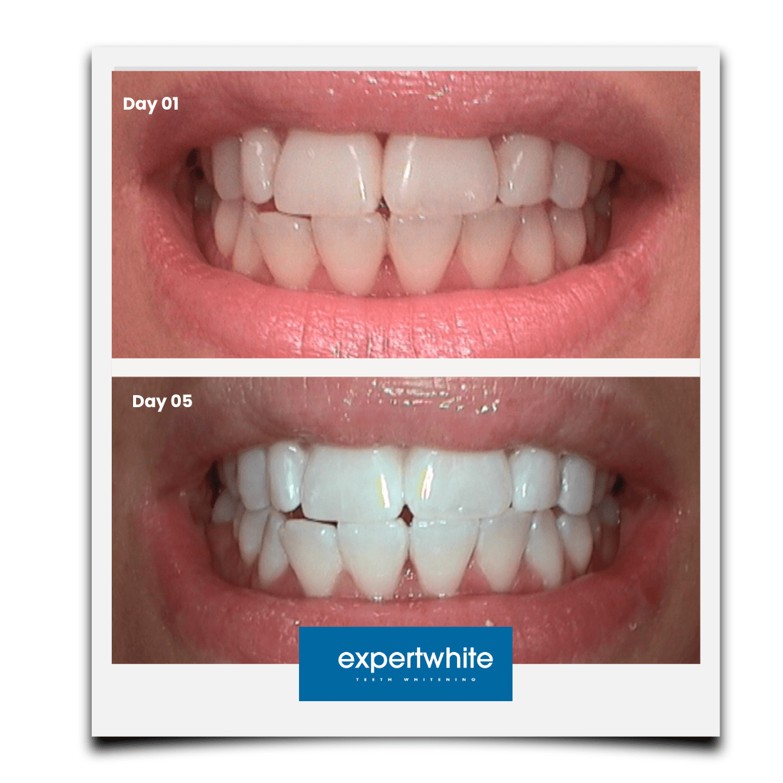 Expertwhite Teeth Whitening Trays Kit Expertwhite Max+ Prefilled Whitening Trays