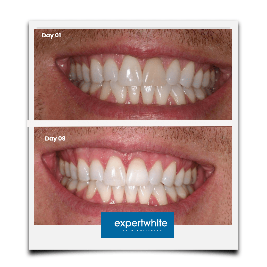 Expertwhite Teeth Whitening Trays Kit Expertwhite Max+ Prefilled Whitening Trays
