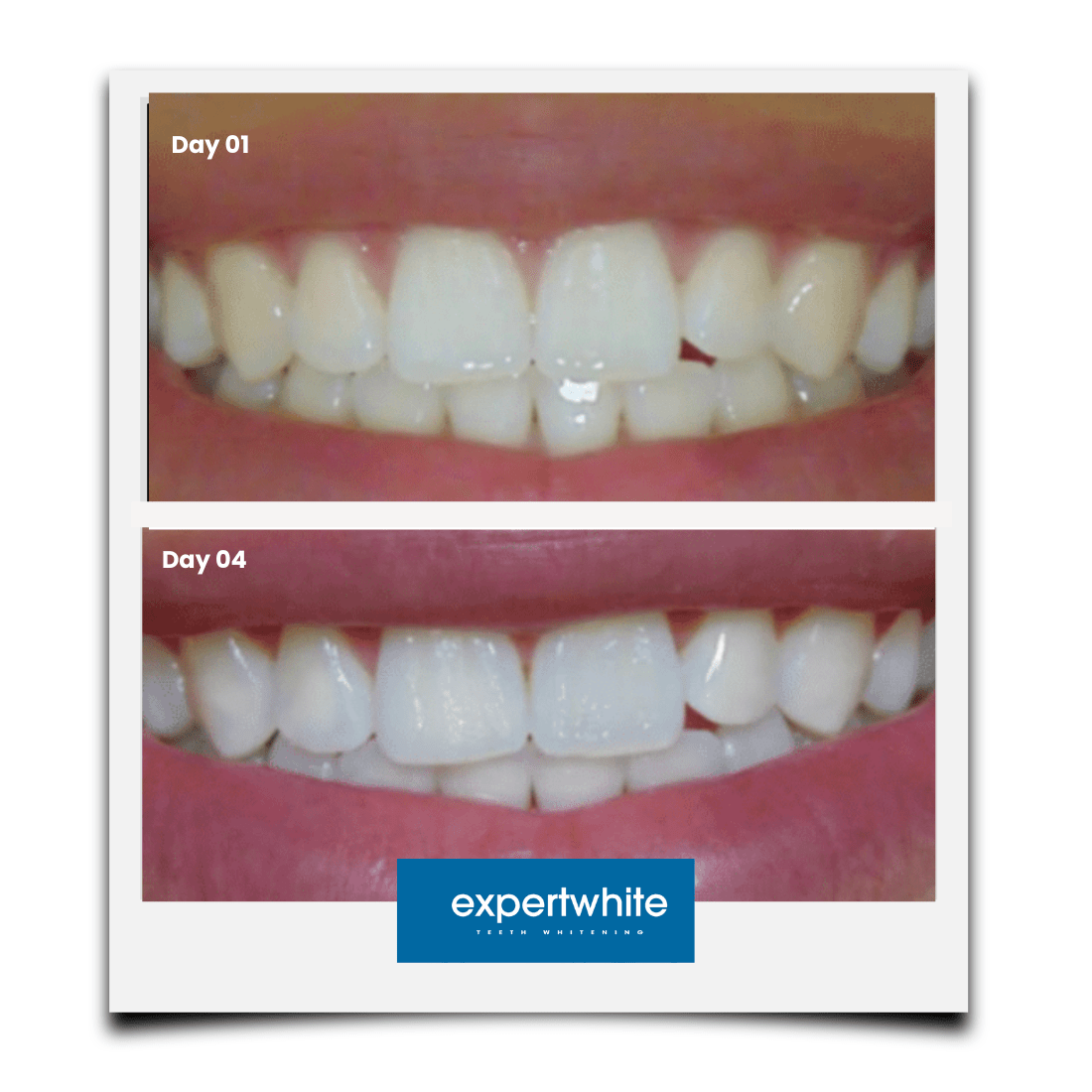 Expertwhite Teeth Whitening Trays Kit Expertwhite Max+ Prefilled Whitening Trays