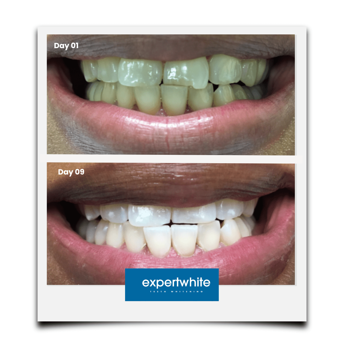 Expertwhite Teeth Whitening Trays Kit Expertwhite Max+ Prefilled Whitening Trays