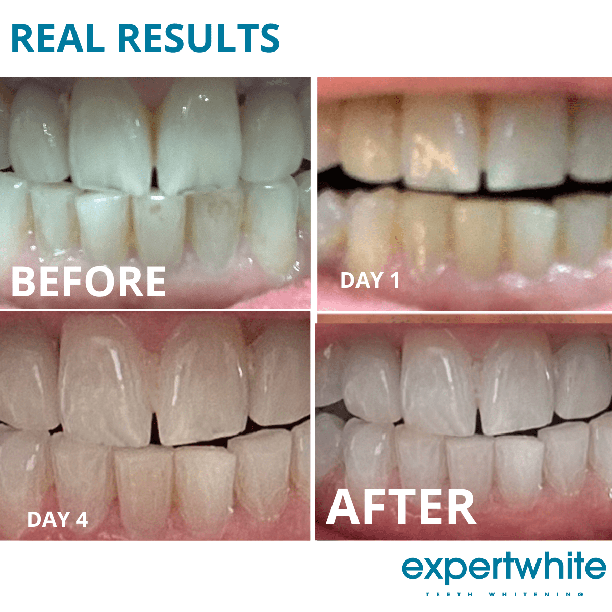 Expertwhite Teeth Whitening Trays Kit Expertwhite Max+ Prefilled Whitening Trays