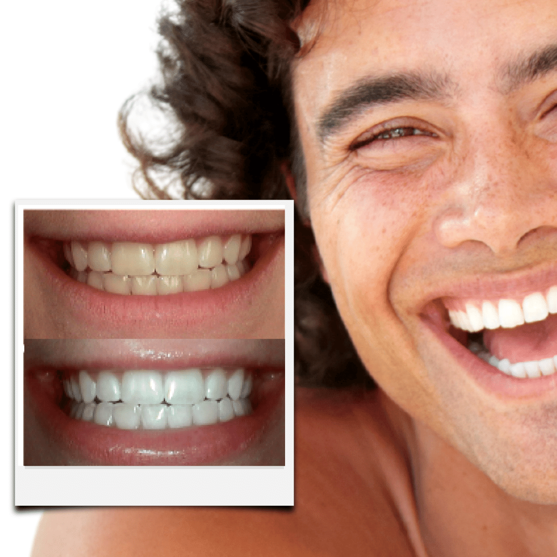 Expertwhitening Teeth Whitening Kit The Teeth Whitening Kit Transformation Bundle (Limited Offer)