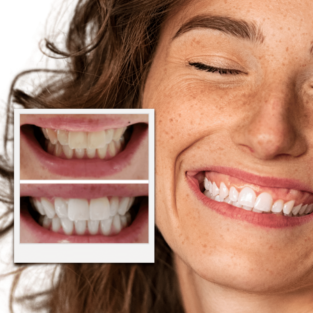 Expertwhitening Teeth Whitening Kit The Teeth Whitening Kit Transformation Bundle (Limited Offer)