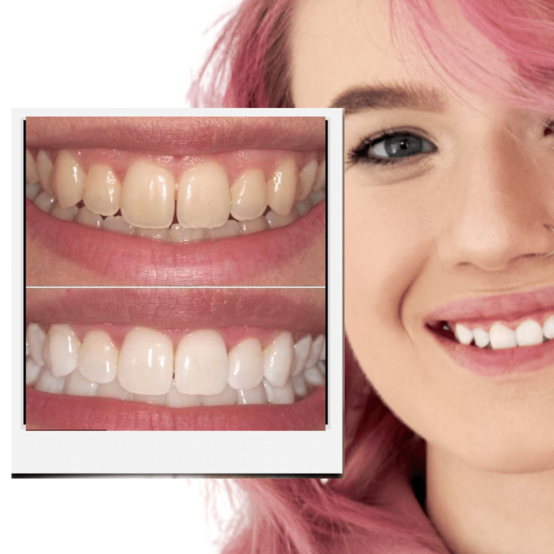Expertwhitening Teeth Whitening Kit The Ultimate Teeth Whitening Kit Bundle (Limited Offer)