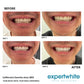Expertwhite Aligner Retainer Cleaner Aligner & Retainer Cleaner –Peroxide Teeth Whitening Foam,  Daily Stain Control, and Brilliantly Clear Retainers.