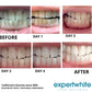 Expertwhite Expertwhite DryFit Teeth Whitening Strips (5-Packs)