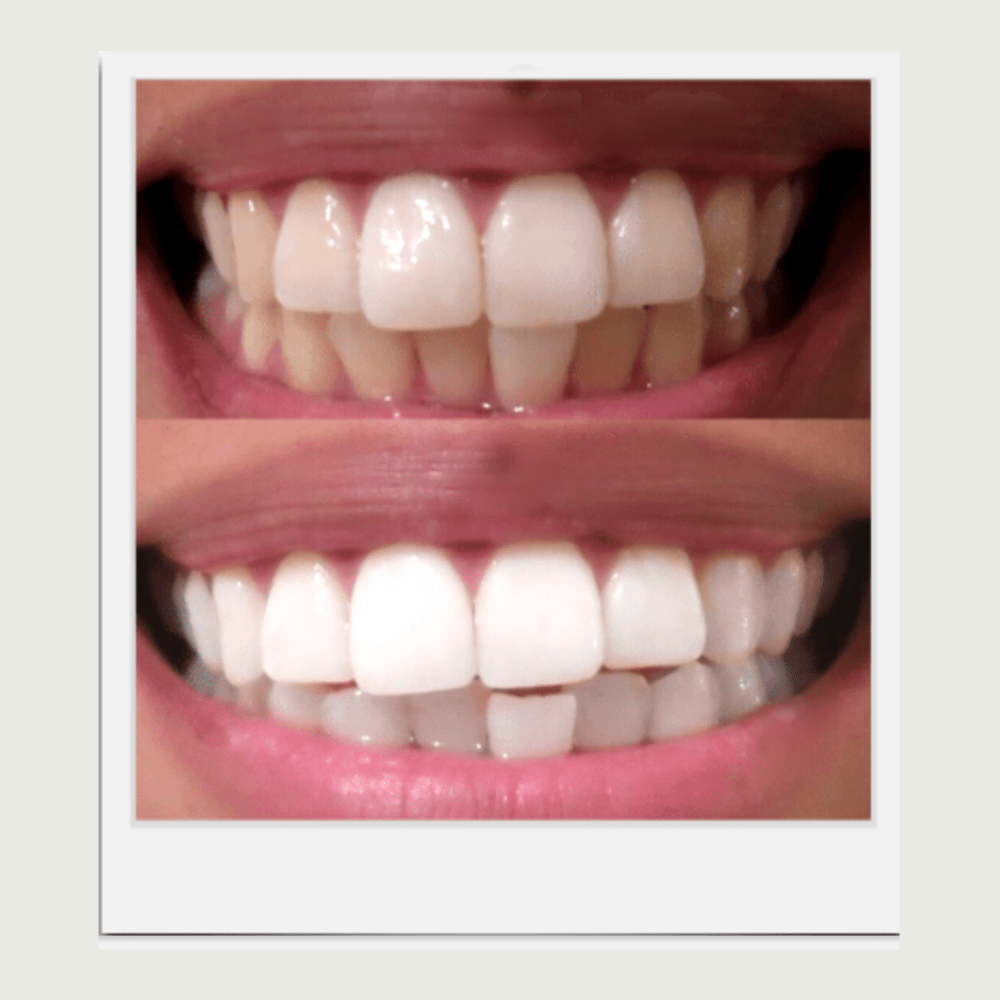 Expertwhite Expertwhite Pro-grade Teeth Whitening Gels (4 Strengths)
