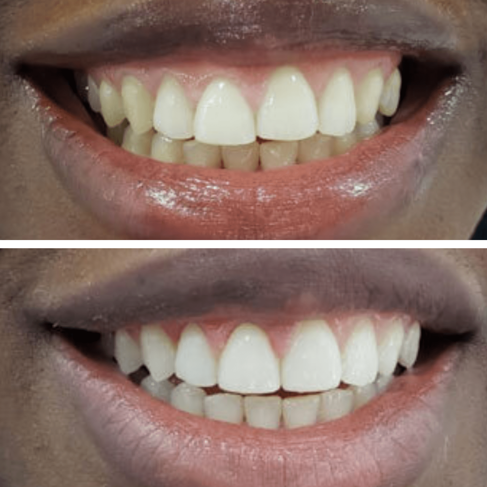 Expertwhite New 12% HP Prefilled Teeth Whitening Trays (20 Trays, 10 Treatments Upper and lower). BrightGlo Max