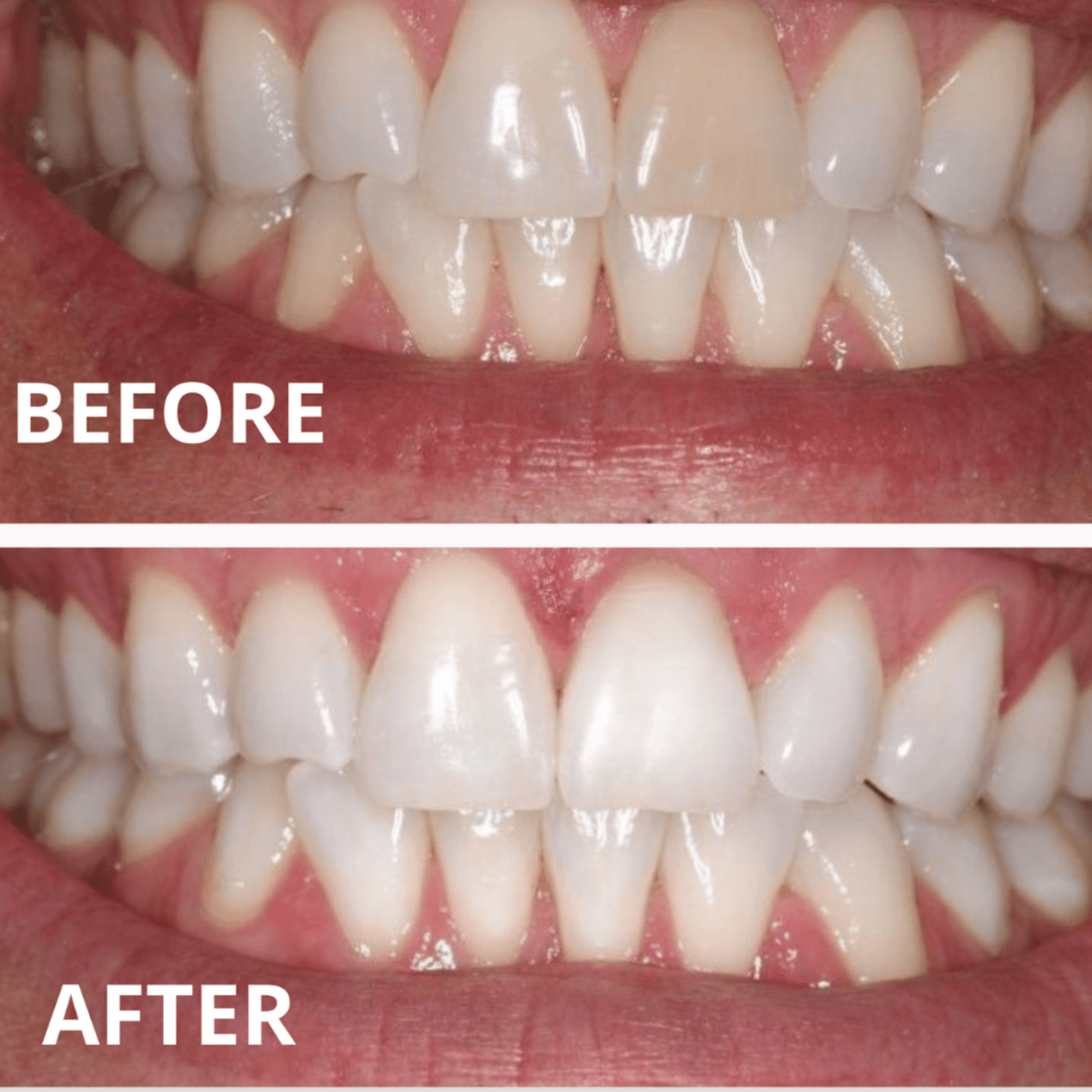 Expertwhite New 12% HP Prefilled Teeth Whitening Trays (20 Trays, 10 Treatments Upper and lower). BrightGlo Max