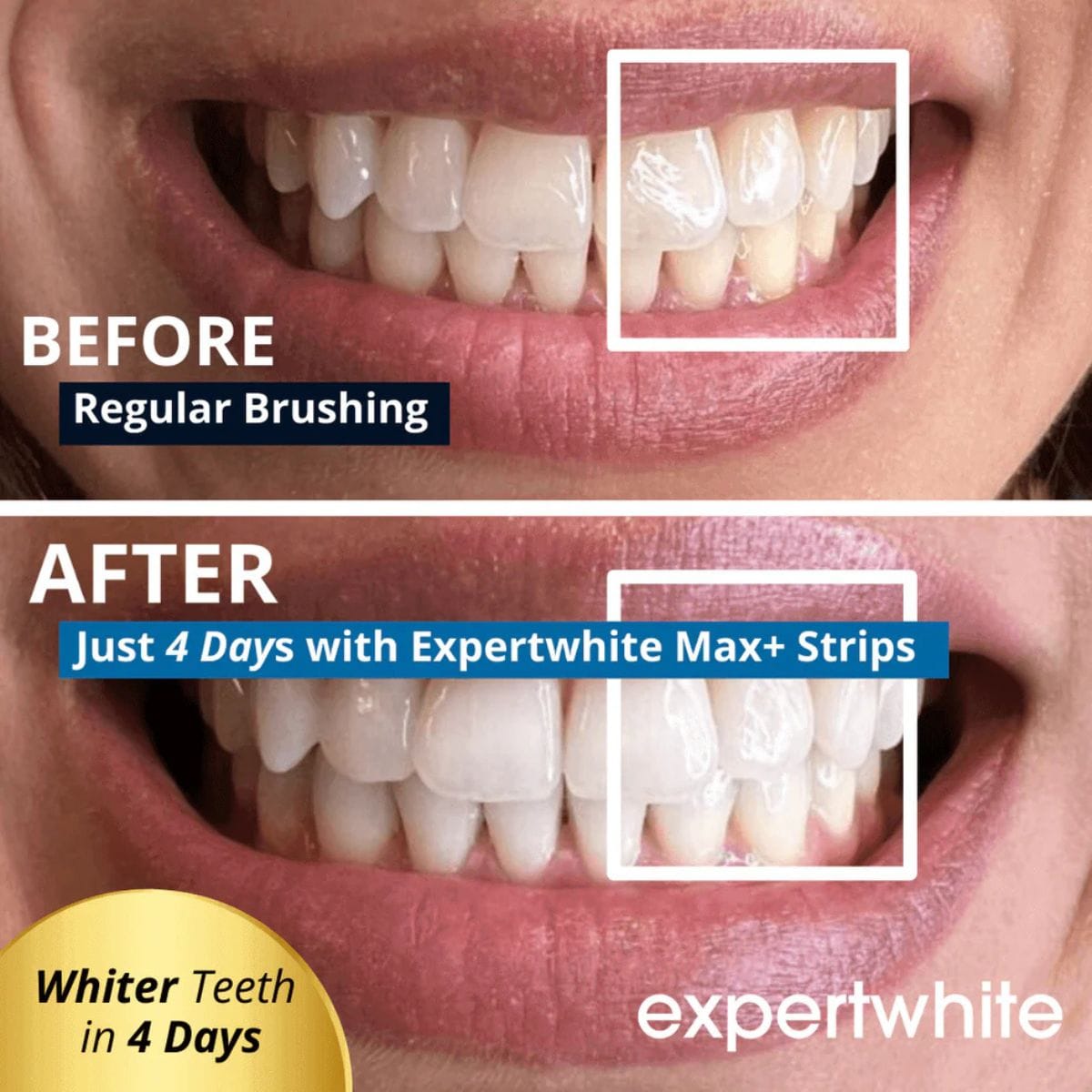Expertwhite Prefilled Whitening Trays 12HP USA (5 Pack) | Expertwhite