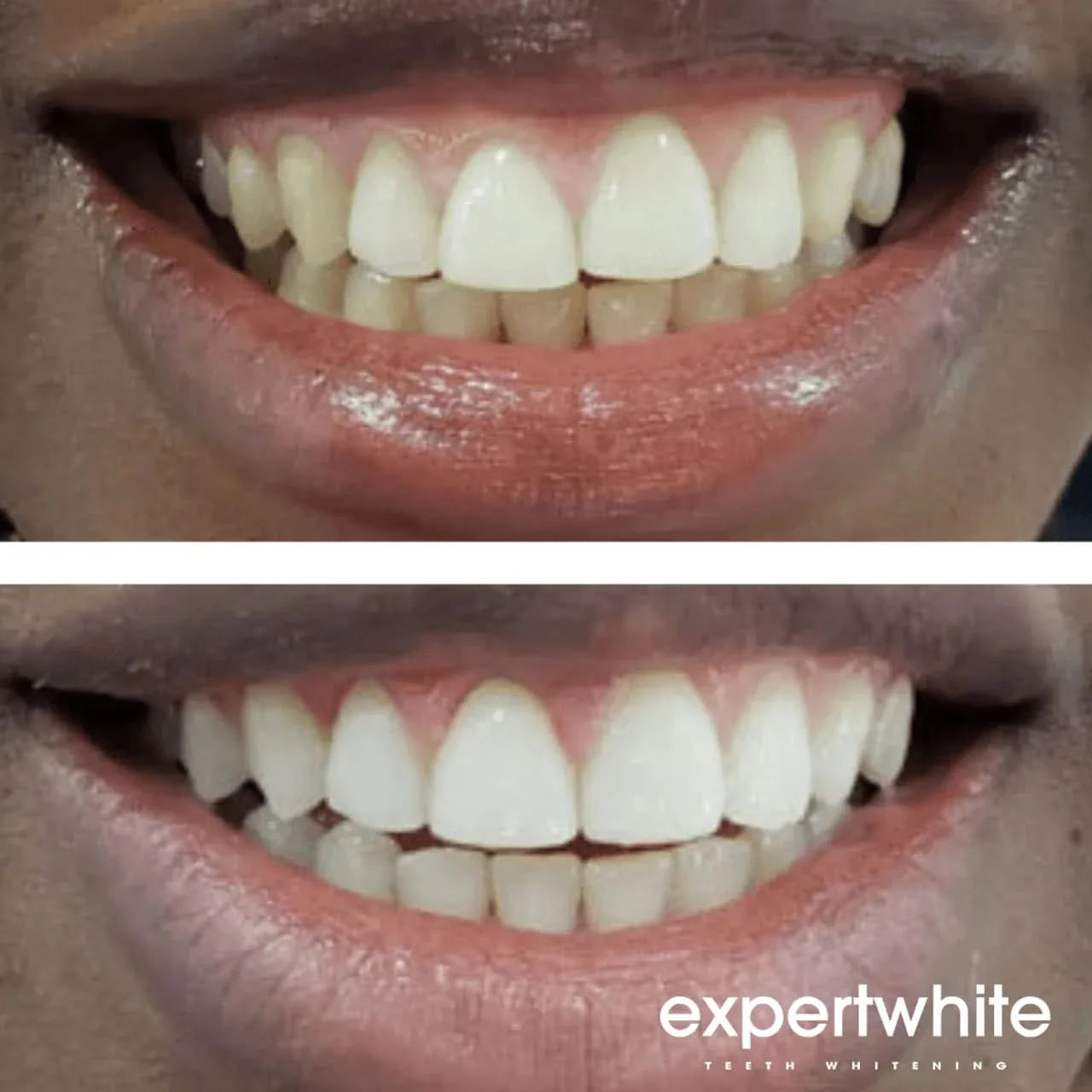 Expertwhite Teeth whitener gel Teeth Whitening Gel – Dentist-Grade Aligner & Tray Whitening | Expertwhite (Made in USA)
