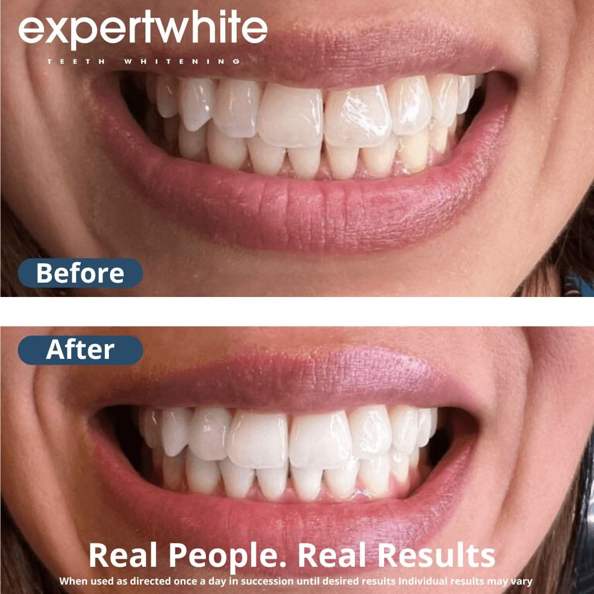 Expertwhite Teeth whitener gel Teeth Whitening Gel – Dentist-Grade Aligner & Tray Whitening | Expertwhite (Made in USA)