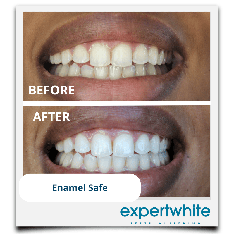 Expertwhite Teeth Whiteners Teeth Whitening Pen – Dentist Grade Peroxide Gel, Erases Stains on the Go - So Your Teeth Are Always White - Ready To Smile Your Best