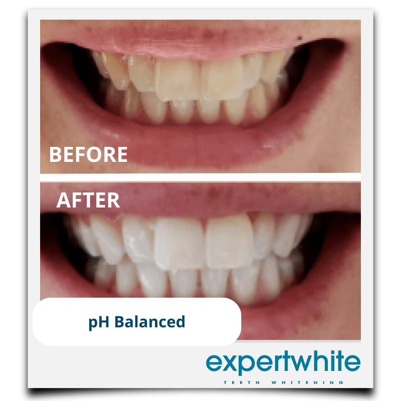 Expertwhite Teeth Whiteners Teeth Whitening Pen – Dentist Grade Peroxide Gel, Erases Stains on the Go - So Your Teeth Are Always White - Ready To Smile Your Best