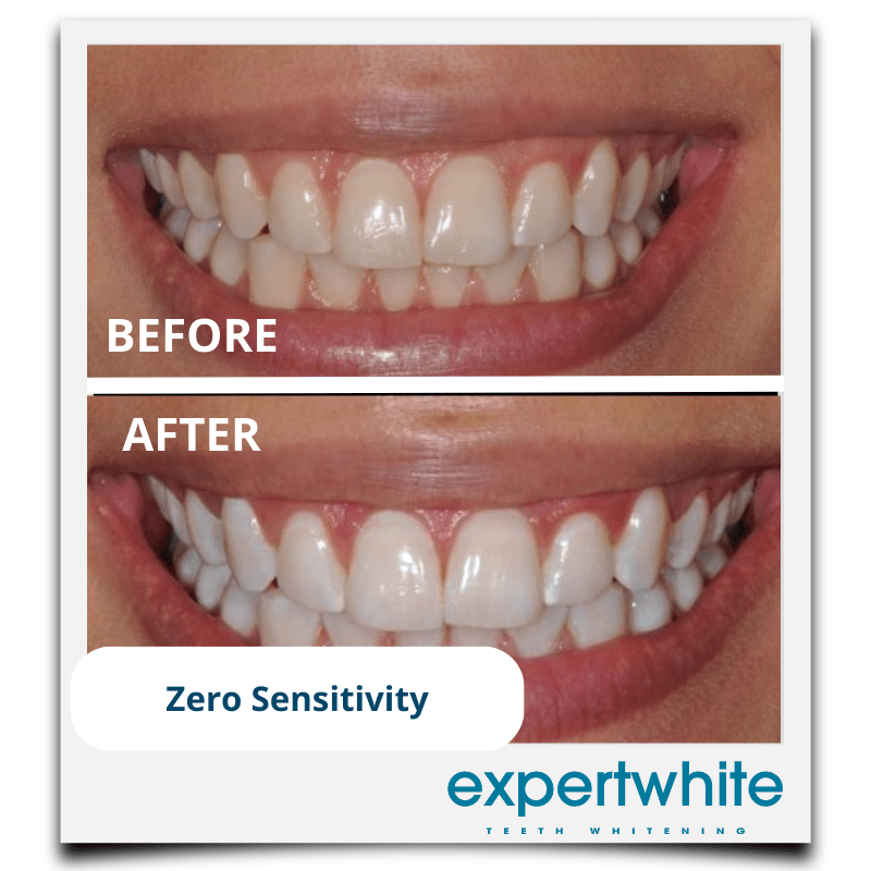 Expertwhite Teeth Whiteners Teeth Whitening Pen – Dentist Grade Peroxide Gel, Erases Stains on the Go - So Your Teeth Are Always White - Ready To Smile Your Best