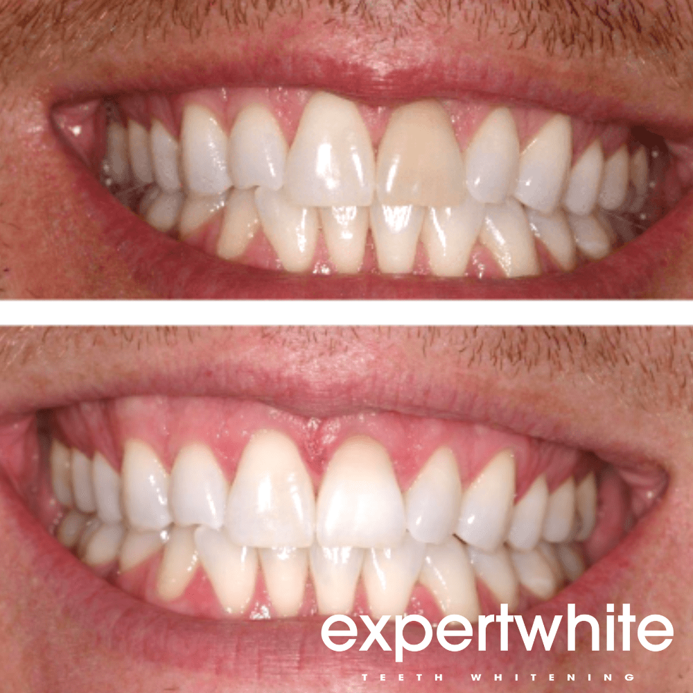 Expertwhite Teeth Whitening Gels 16%CP Teeth Whitening Gel (Gentle, Nite)