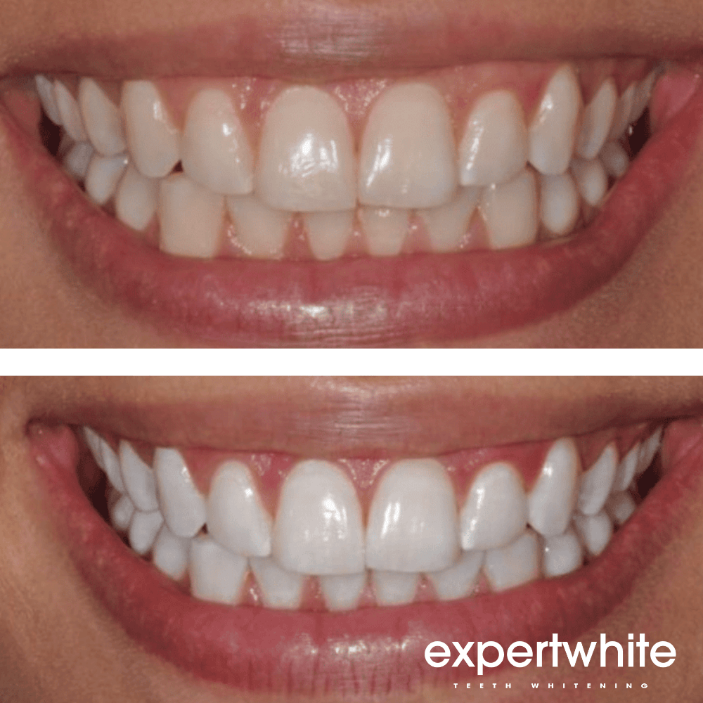 Expertwhite Teeth Whitening Gels 20-Gels | Expertwhite 22% CP Pro Teeth Whitening Gel (45-Minutes) SAVE 50%