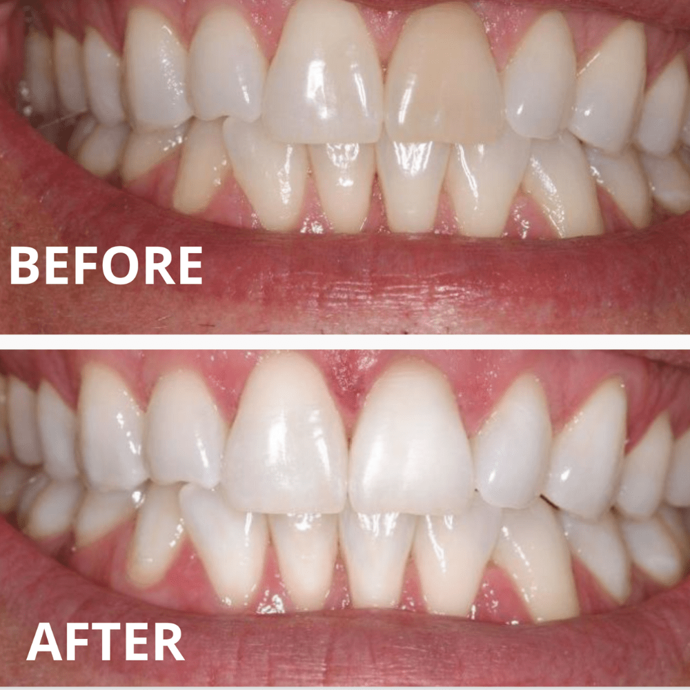Expertwhite 44 (15 minutes) Strongest Teeth Whitening Gel