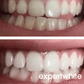 Expertwhite Teeth Whitening Gels 22%CP Teeth Whitening Gel (Pro, 45-minutes)