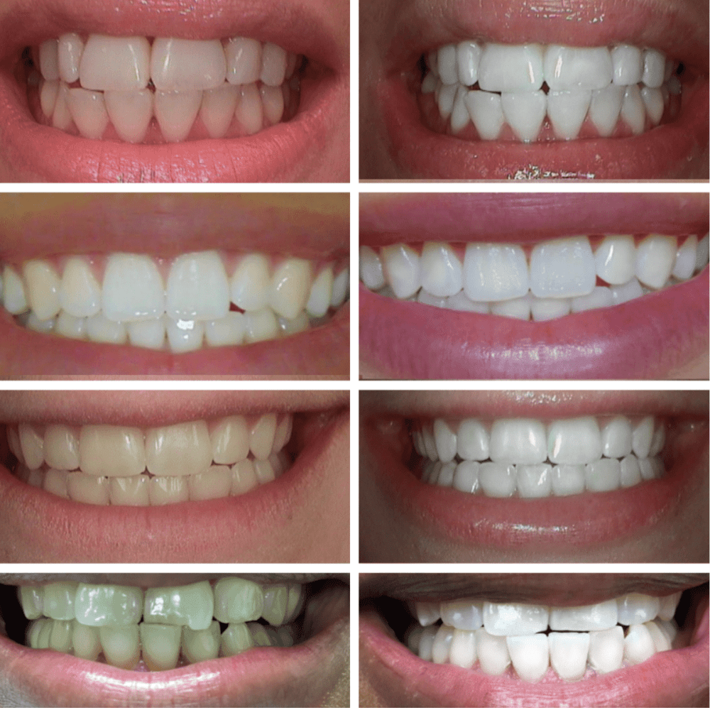 Expertwhite Teeth Whitening Gels 35%CP Teeth Whitening Gels  (Rapid, 30-minutes)