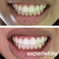Expertwhite Teeth Whitening Gels 44%CP Teeth Whitening Gel (Extreme, 15-minutes)