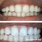 Expertwhite Teeth Whitening Gels Expertwhite Ultra+ 44% Teeth Whitening Gel – (15-Minutes)