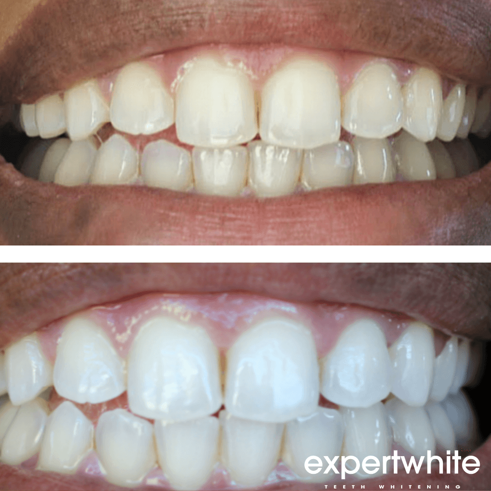 Expertwhite Teeth Whitening Gels Expertwhite Ultra+ 44% Teeth Whitening Gel – (15-Minutes)