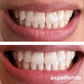 Expertwhite Teeth Whitening Gels Expertwhite Ultra+ 44% Teeth Whitening Gel – 8 Pack | Save 30%