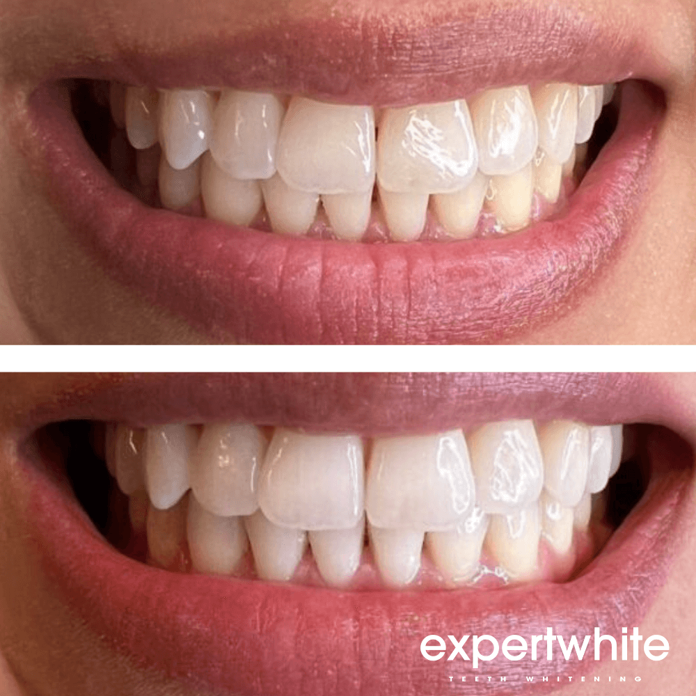 Expertwhite Teeth Whitening Gels Expertwhite Ultra+ 44% Teeth Whitening Gel – 8 Pack | Save 30%