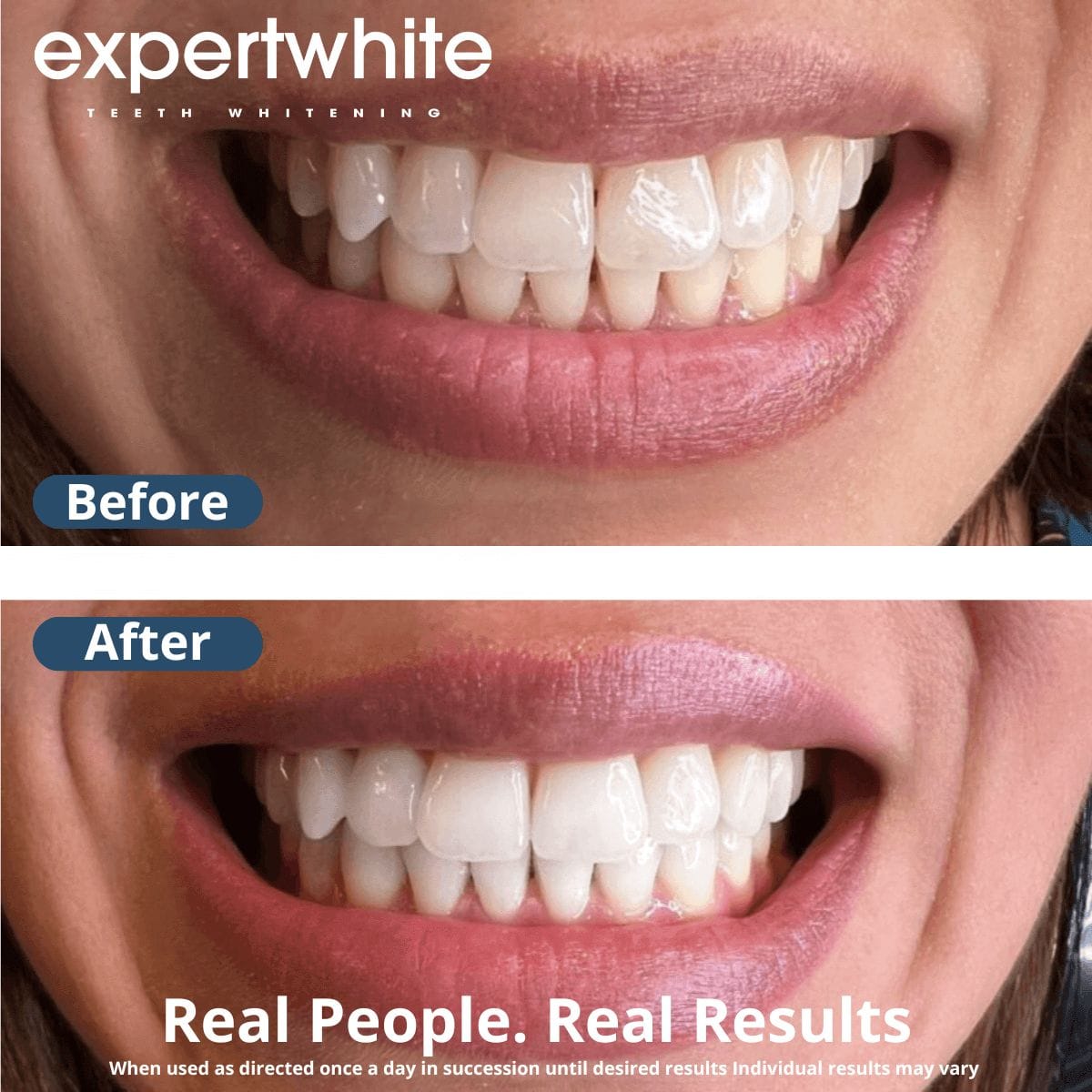 Teeth Whitening Gel 22CP Pro+ – Dentist-Strength 45-Minute