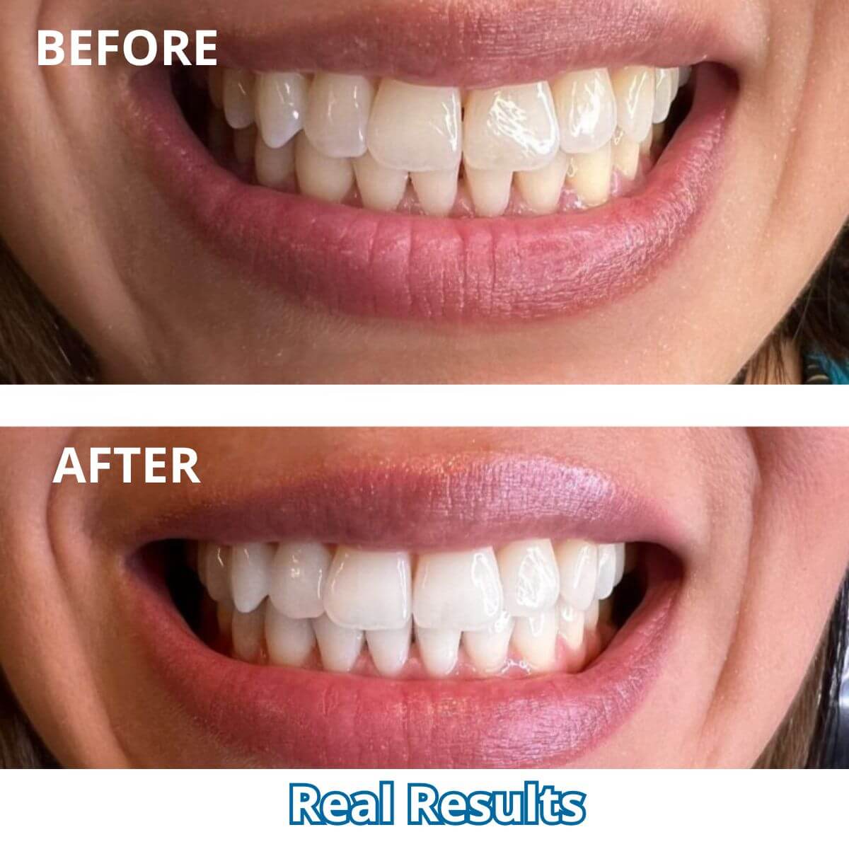 Expertwhite Teeth Whitening Kit Expertwhite LED Smile Radiance Teeth Whitening Kit