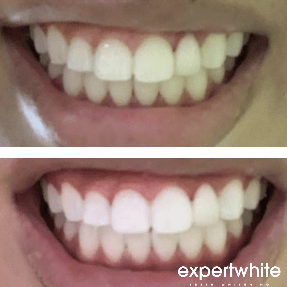 Expertwhite Teeth Whitening Kit LED InstaGlo Kit