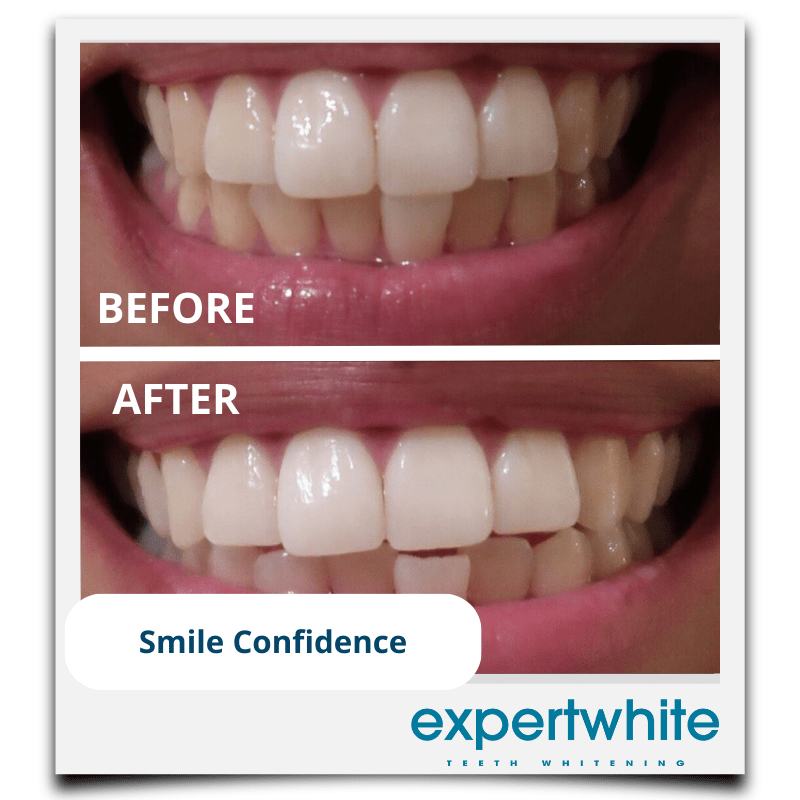 Expertwhite Teeth Whitening Kit LED One Kit Expertwhite Brilliance Boost Teeth Whitening Kit