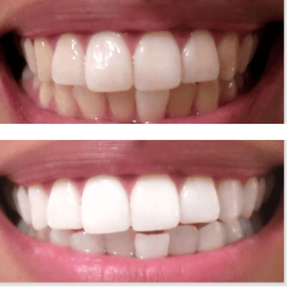 Expertwhite Teeth Whitening Kit LED Teeth Whitening Kit Max+ LED | Expertwhite