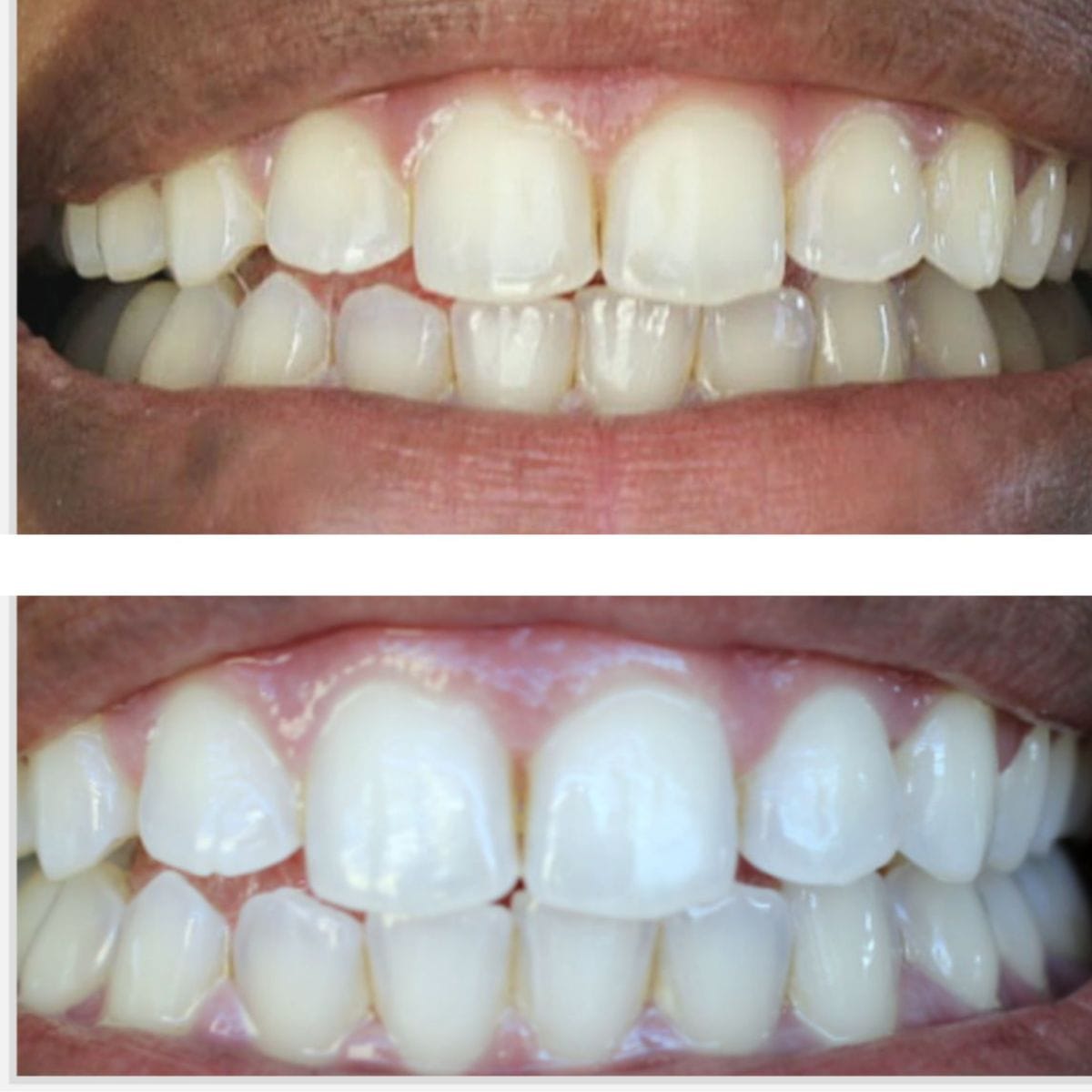 Expertwhite Teeth Whitening Kit LED Teeth Whitening Kit Max+ LED | Expertwhite