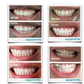 Expertwhite Teeth Whitening Kit Teeth Whitening Kit – Dentist-Grade LED Light-Activated Gel Tray System
