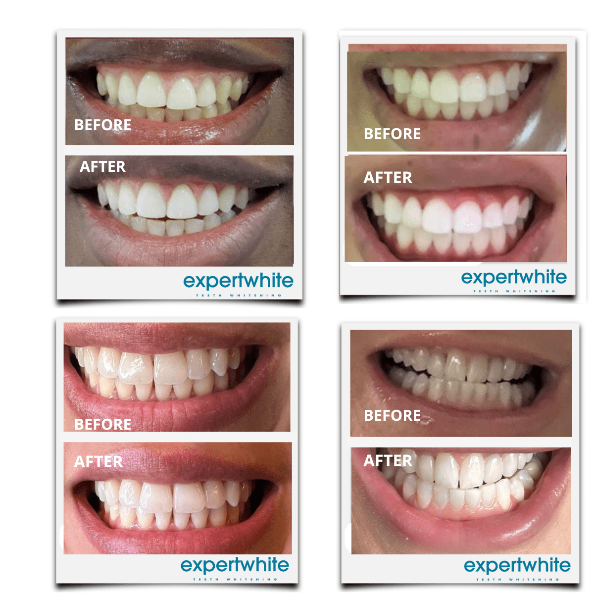 Expertwhite Teeth Whitening Kit Teeth Whitening Kit – Dentist-Grade LED Light-Activated Gel Tray System