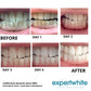 Expertwhite Teeth Whitening Kit Teeth Whitening Kit – Dentist-Grade LED Light-Activated Gel Tray System