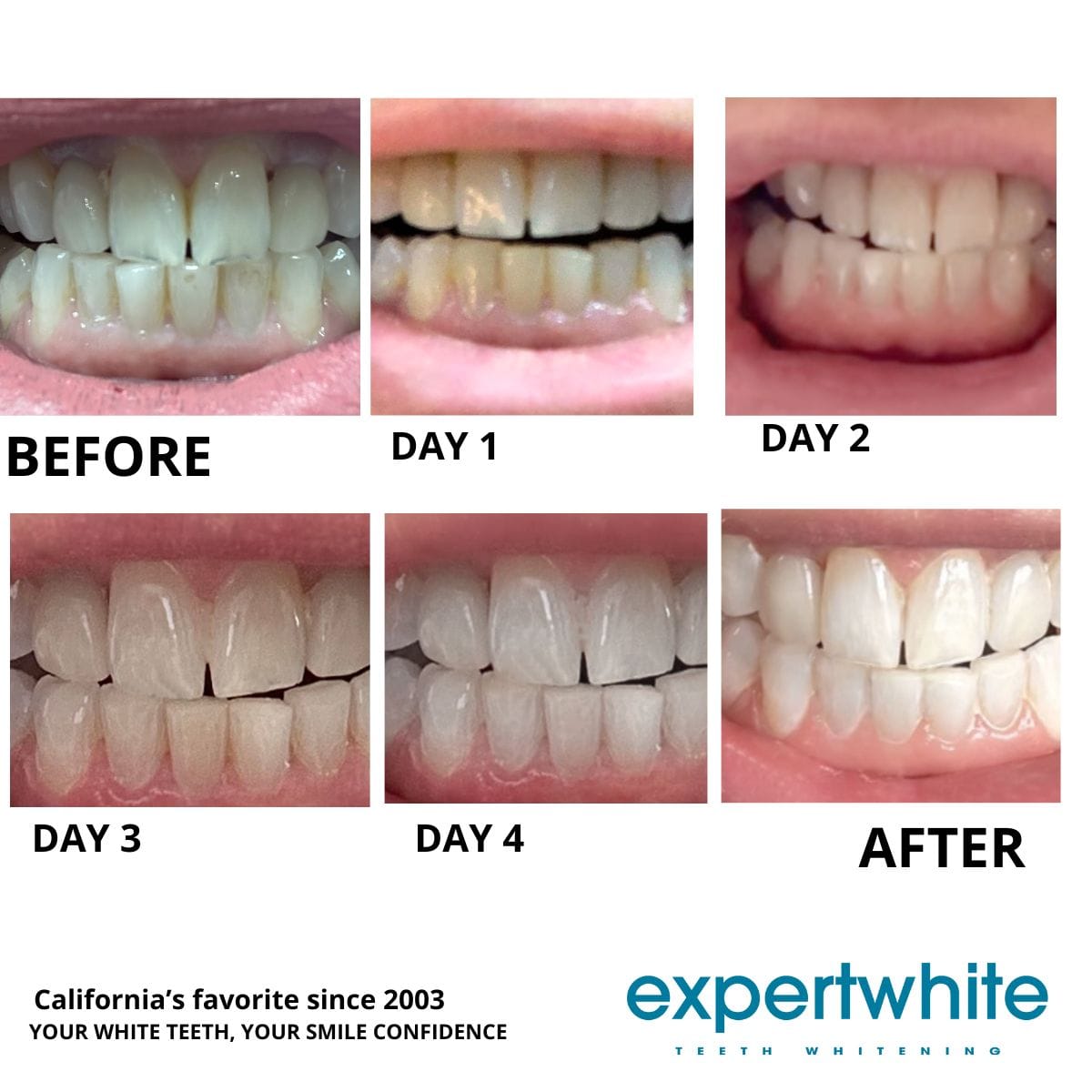 Expertwhite Teeth Whitening Kit Teeth Whitening Kit – Dentist-Grade LED Light-Activated Gel Tray System