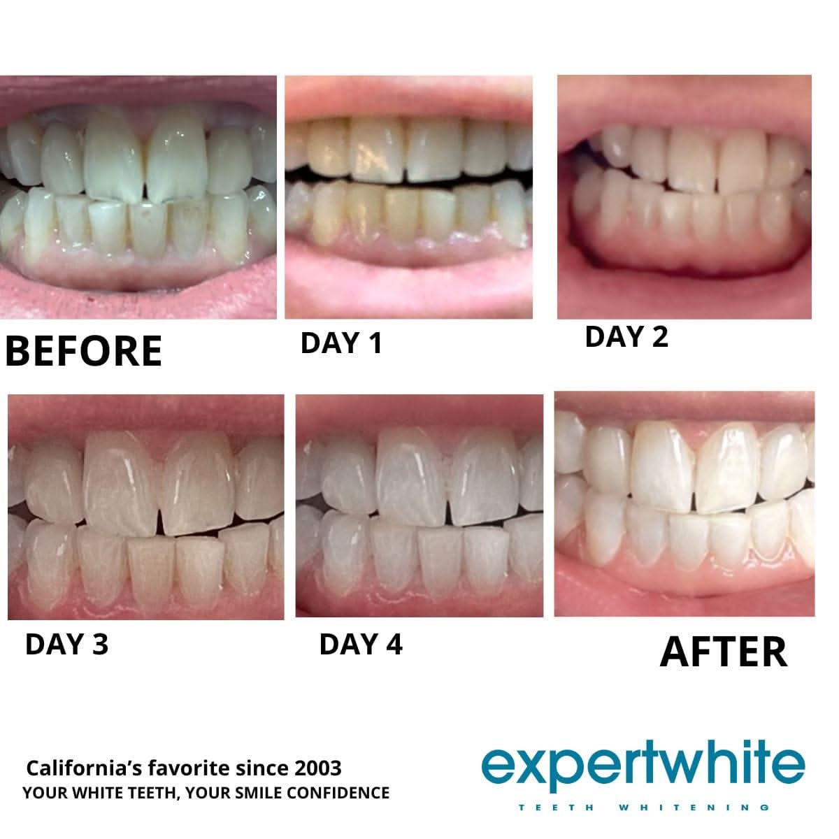 Expertwhite Teeth Whitening Kit Teeth Whitening Kit – Dentist-Grade LED Light-Activated Gel Tray System