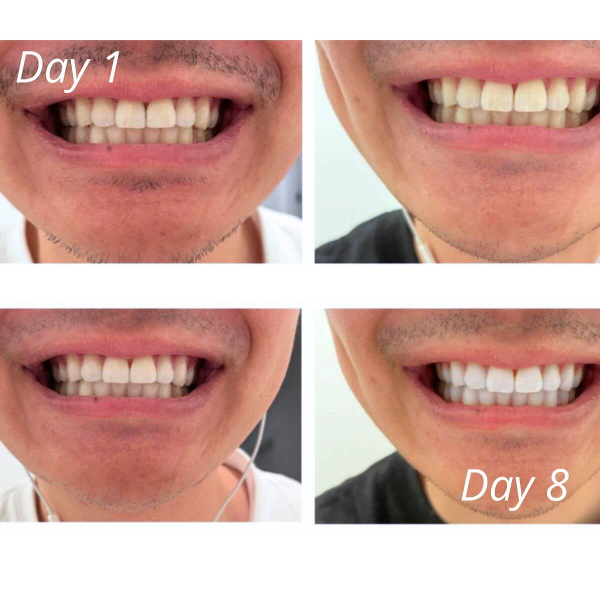 Expertwhite Teeth Whitening strips Expert White Strips: Teeth Whitening Strips