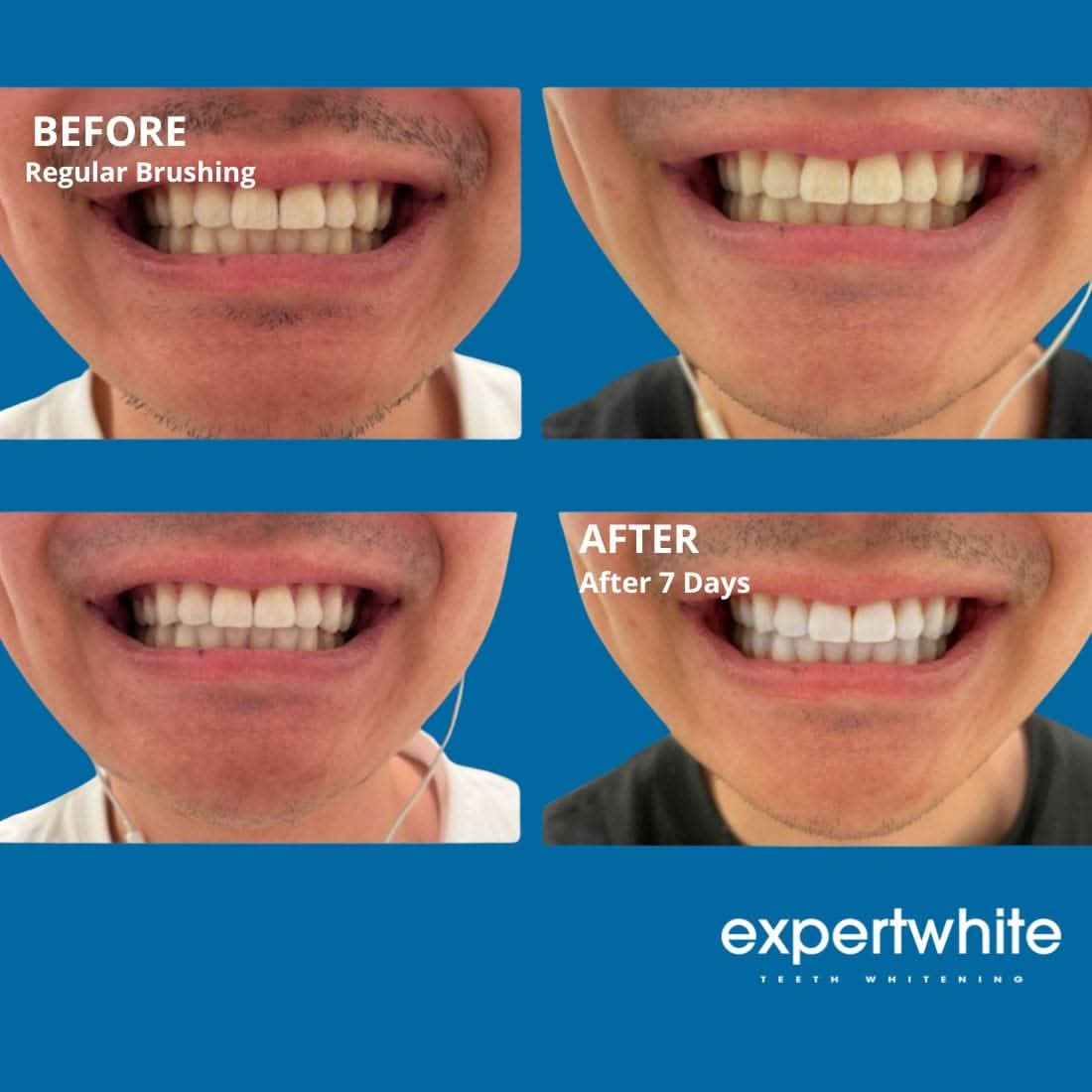 Expertwhite Teeth Whitening strips Expertwhite DryFit Teeth Whitening Strips